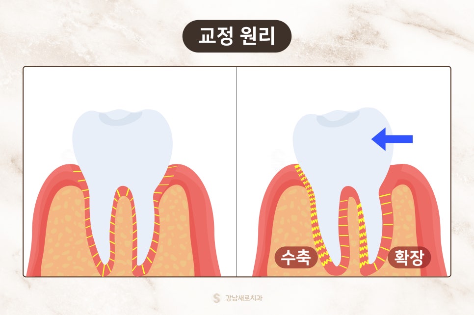 교정 부작용 자세히 알아보기 - 얼굴 변화 원리와 이유 [ 예방 및 대처 방법 ] [ 강남새로치과 ] 관련 이미지 1