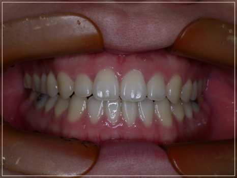 입안다물어짐 비수술로 해결이 가능하다면 관련 이미지 5