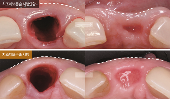최소 시간 최소 기간으로 최대 효율 (임플란트기간 임플란트시간) 관련 이미지 3