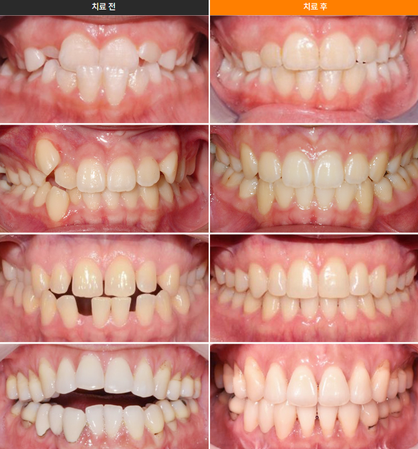 투명 교정 전격 비교 [ 인비절라인vs나노라이너 ] [ 강남새로치과 ] 관련 이미지 4