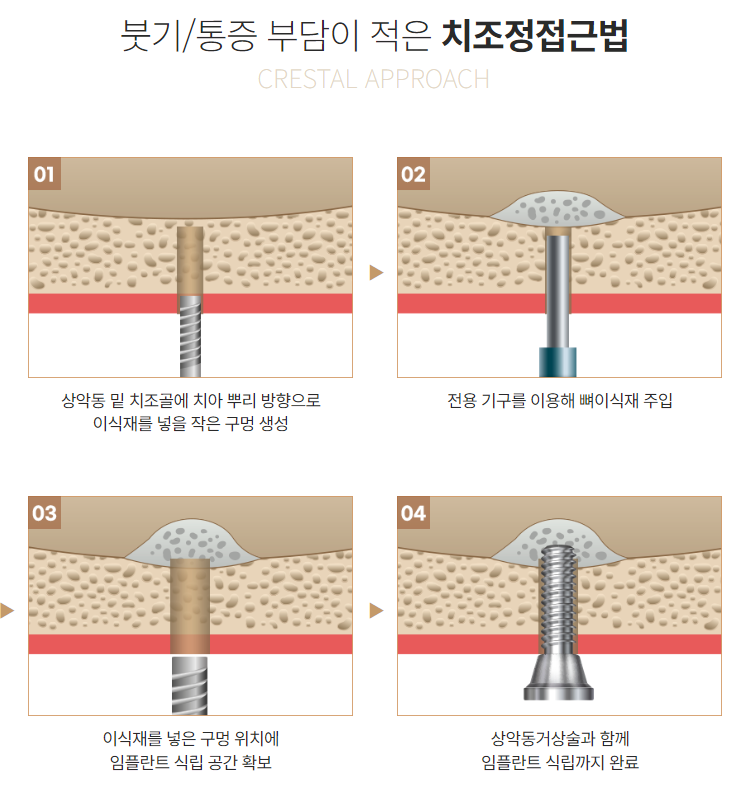 최소식립 65세 70대 임플란트 (전체임플란트) 관련 이미지 2