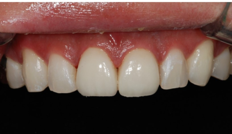 법랑질 삭제를 최소로 하는 헨리라미네이트 관련 이미지 13