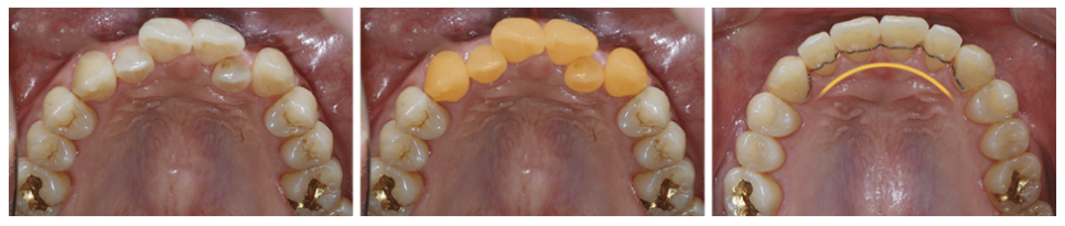 4개월만에 끝나는 부분교정 (급속교정후기) 관련 이미지 4