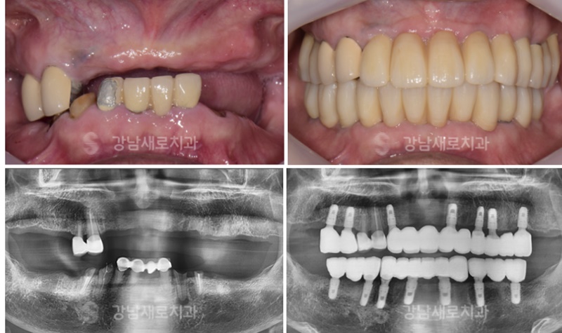 강남네비게이션임플란트 장점 관련 이미지 9