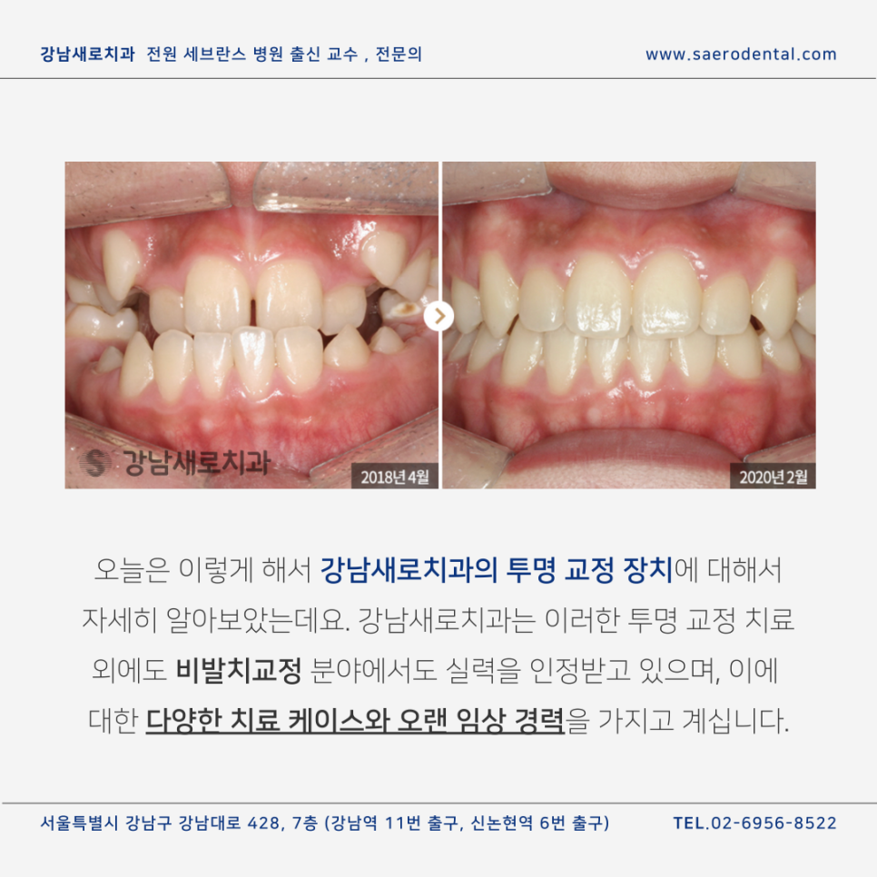 강남새로치과의 투명교정장치종류, 인비절라인과 나노라이너 관련 이미지 12