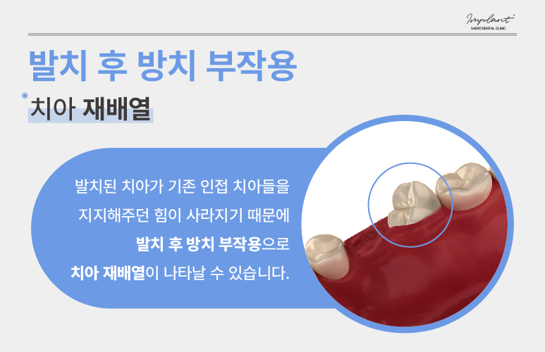 발치 후 임플란트 해야 하는 이유 (임플란트안하면) 관련 이미지 3