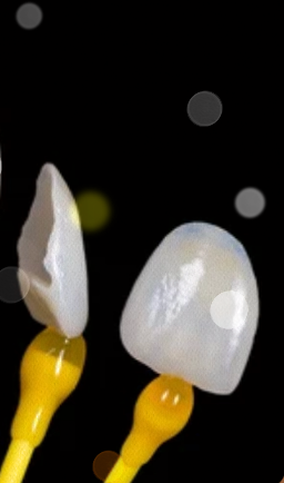 기안라미네이트 치아 손상 걱정없이 보다 안전한 진행 방법? 관련 이미지 13