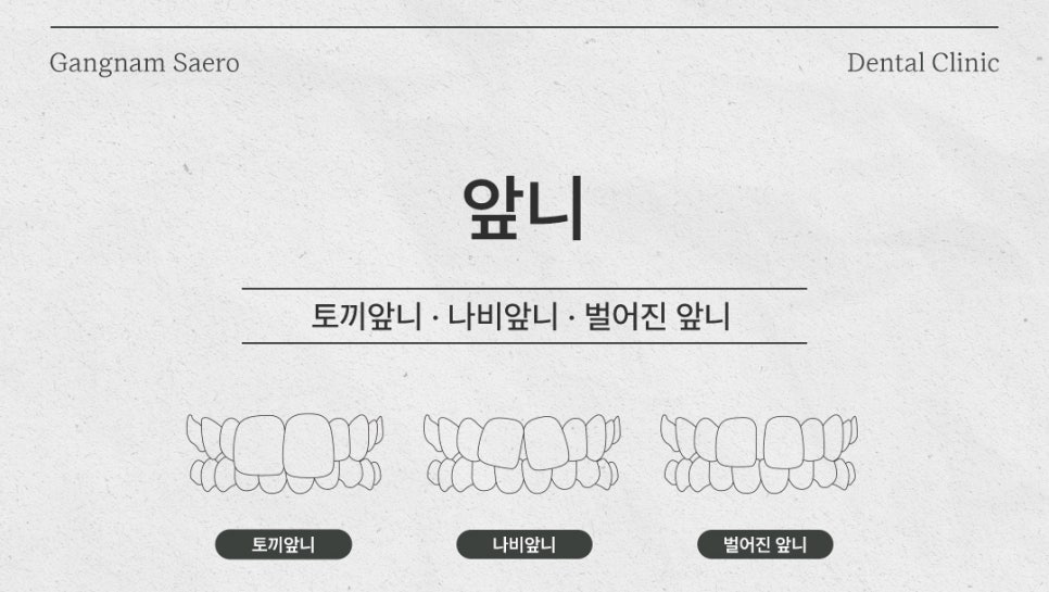 치아교정 으로 해결하는 외모 콤플렉스 (부정교합교정 앞니교정 잇몸교정) 관련 이미지 4