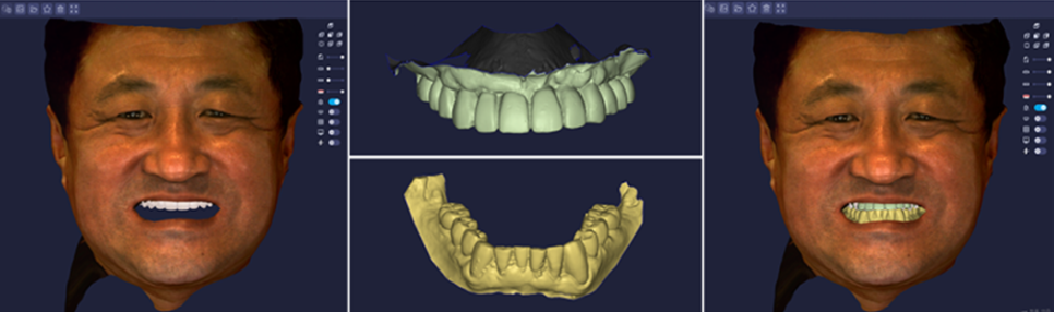 임플란트부작용 걱정된다면 강남새로치과 네비게이션 임플란트 (임플란트통증) 관련 이미지 4