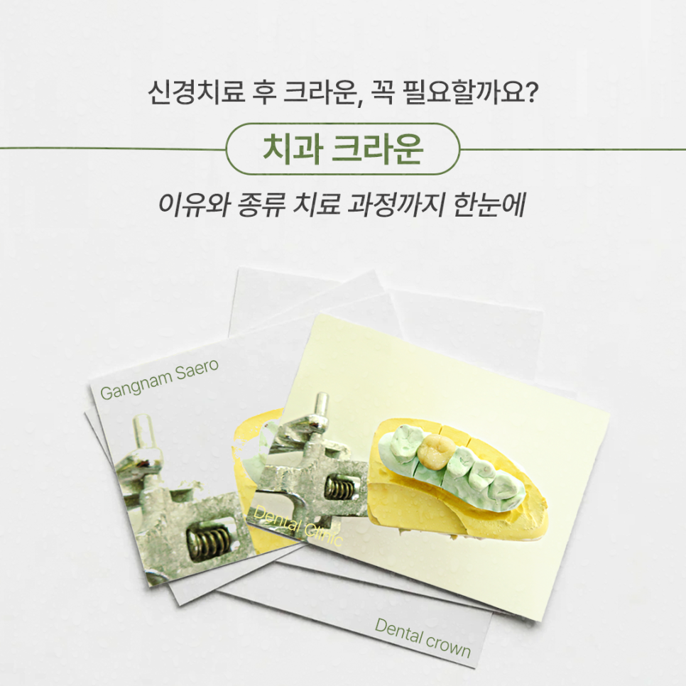 After Root Canal Treatment, Is a Crown Really Necessary? (Dental Crown) image 1