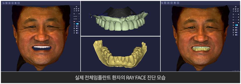 부작용 줄이는 임플란트 [ 네비게이션 임플란트 ] [ 강남새로치과 ] 관련 이미지 3