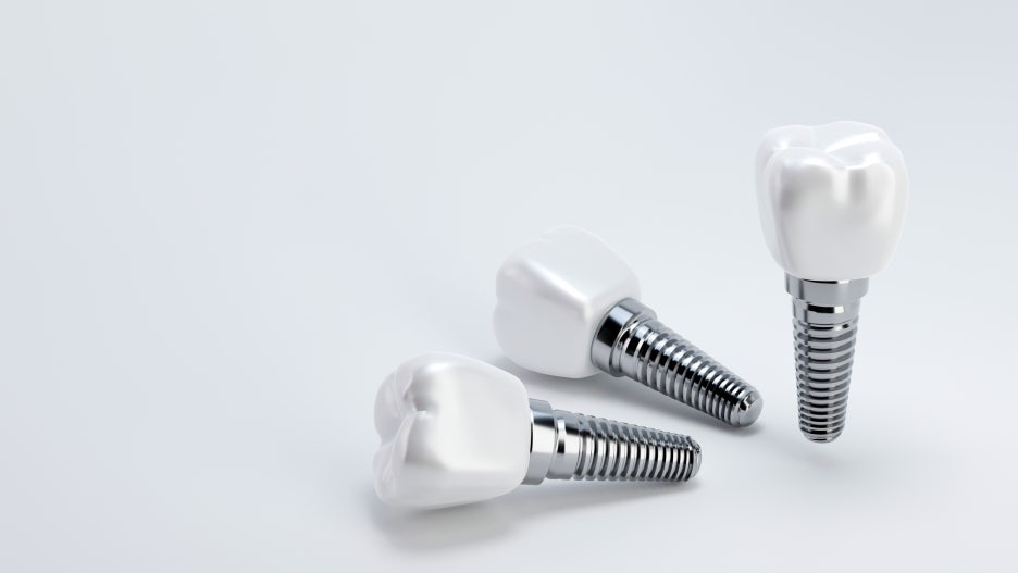 임플란트 치료, 보철물 수명, 교체 시기, 구강을 위해 알아둡시다. 관련 이미지 1