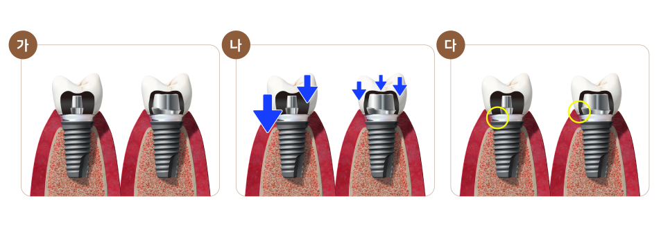 임플란트 부작용 자세히 알아보기(1) 임플란트 보철 (크라운, 지대주, 픽스쳐) 부작용 [ 예방 및 대처 방법 ] [ 강남새로치과 ] 관련 이미지 6