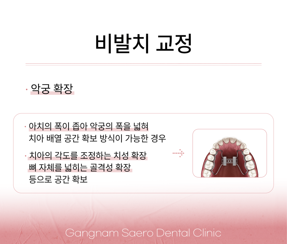 비발치 교정이 다 좋지만은 않은 이유 (발치교정 이유) 관련 이미지 4