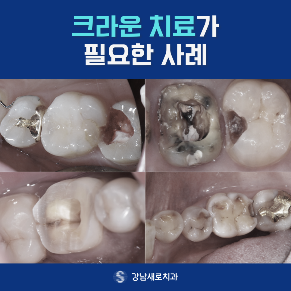 강남충치치료, 상태에 맞는 치료 방법을 선택하려면? 관련 이미지 5