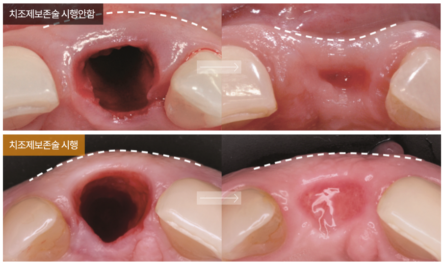 임플란트 영구적이 아닌가요? (임플란트수명) 관련 이미지 6