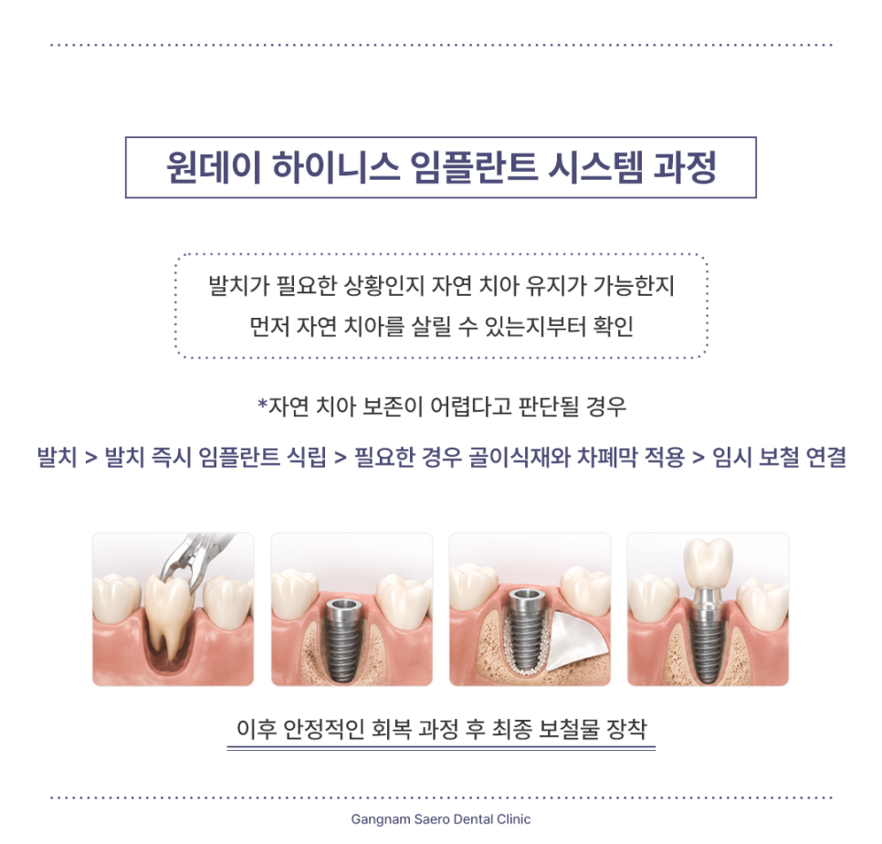 Shortening the Implant Treatment Period: From Tooth Extraction to Implant Placement with a One-Day System image 5
