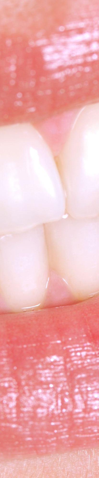 부정교합 교정치료, 비발치로 진행하려면? 관련 이미지 6