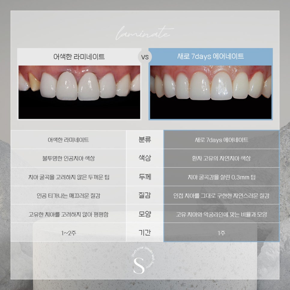 라미네이트 대체 시술 에어네이트 (삭제제로라미네이트) 관련 이미지 2