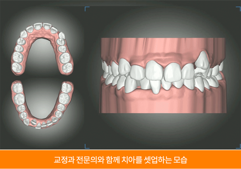 강남투명교정, 강남새로치과 나노라이너의 차별점 관련 이미지 5