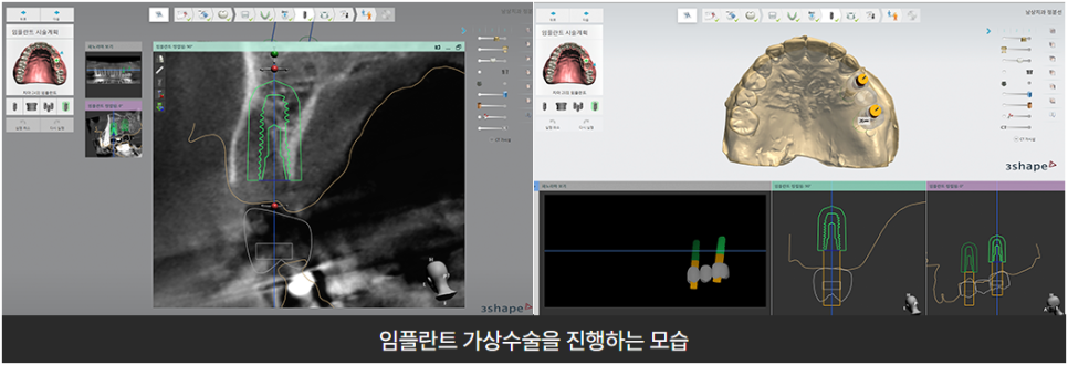 부작용 줄이는 임플란트 [ 네비게이션 임플란트 ] [ 강남새로치과 ] 관련 이미지 5
