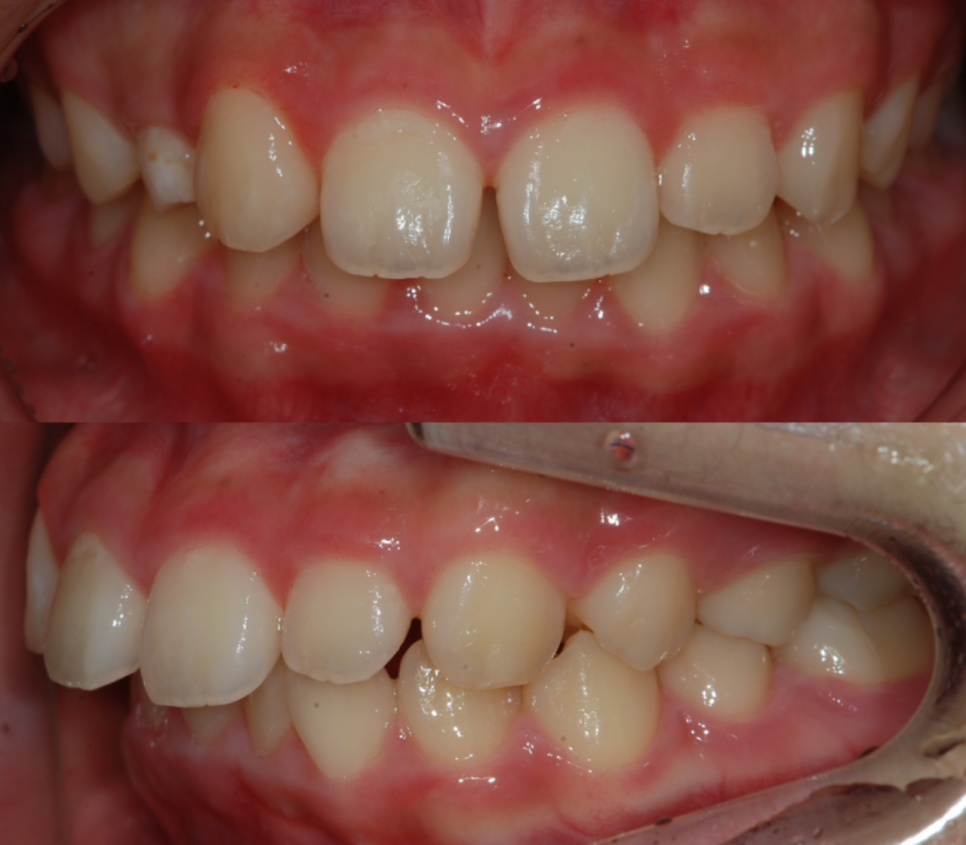 콤플렉스인 뻐드렁니 돌출입 교정으로 개선이 가능할까? 관련 이미지 5