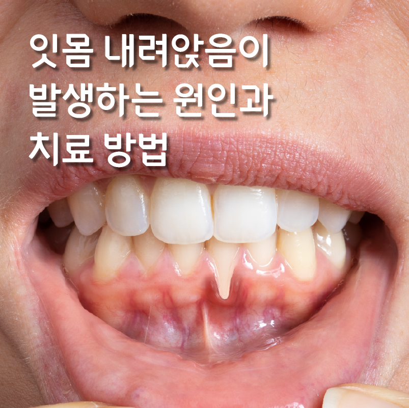 잇몸내려앉음이 발생하는 원인을 제대로 알아야 관련 이미지 1