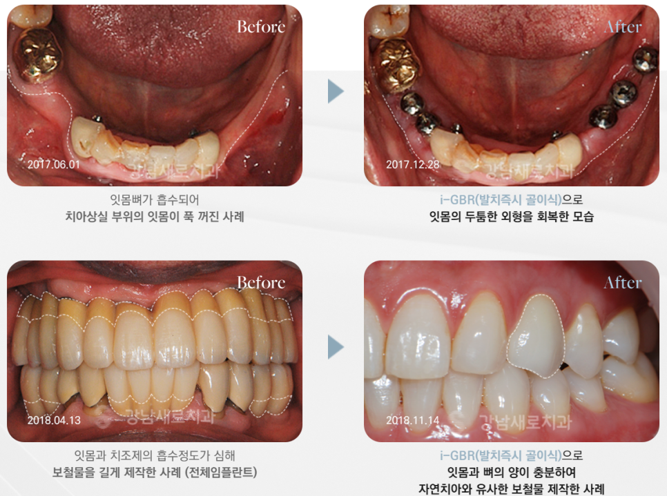 Dental Implant Side Effects: Gums (Periodontal and Gum Tissue Damage) — Prevention and Management image 7