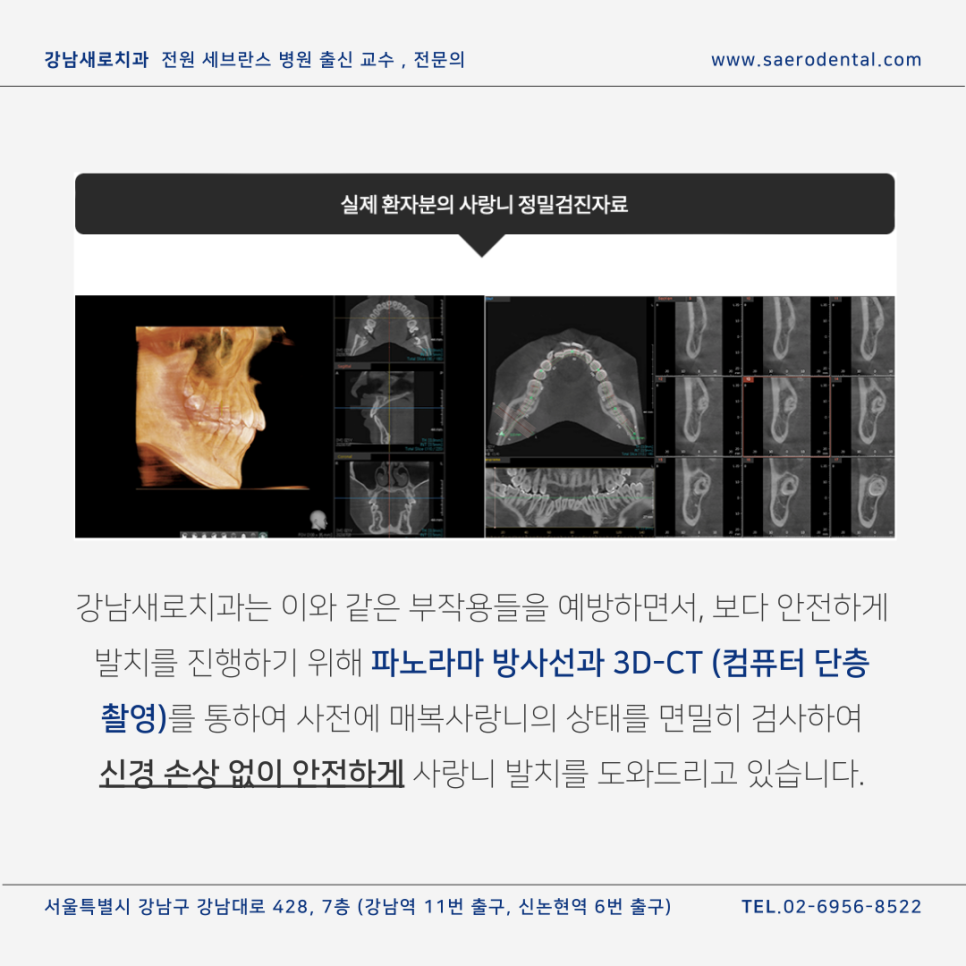강남사랑니치과, 매복사랑니를 더욱 효율적으로 발치하려면 관련 이미지 8