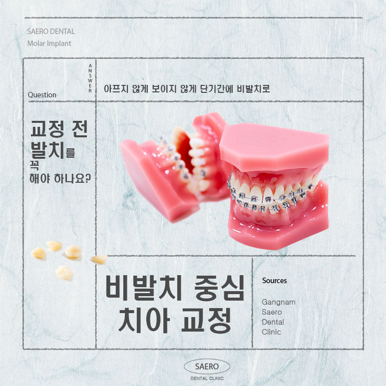 교정 전 발치 필수인가요? (비발치 중심 치아 교정) 관련 이미지 1