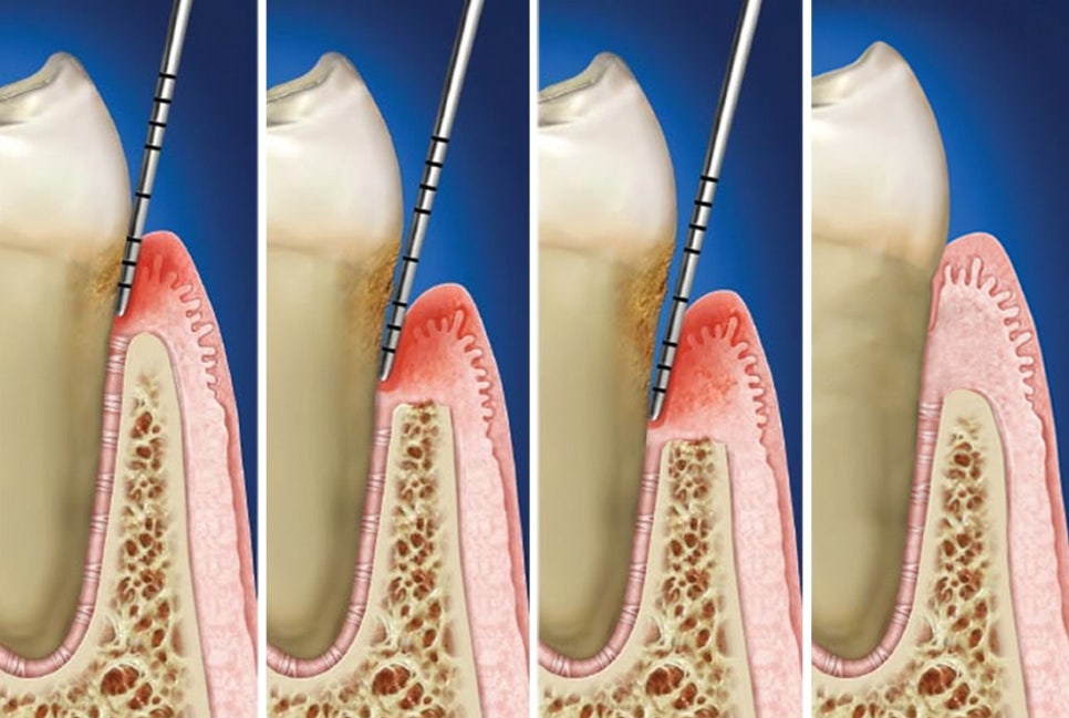 잇몸에서 피가 난다면, 관련 이미지 9