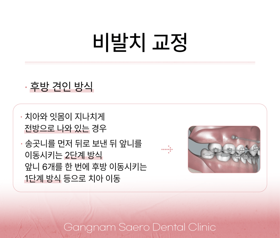비발치 교정이 다 좋지만은 않은 이유 (발치교정 이유) 관련 이미지 6
