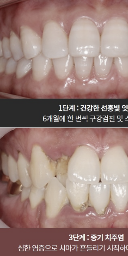치은염 증상 어떠한 문제들이 있을까요? 관련 이미지 1