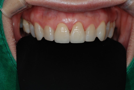 법랑질 삭제를 최소로 하는 헨리라미네이트 관련 이미지 8