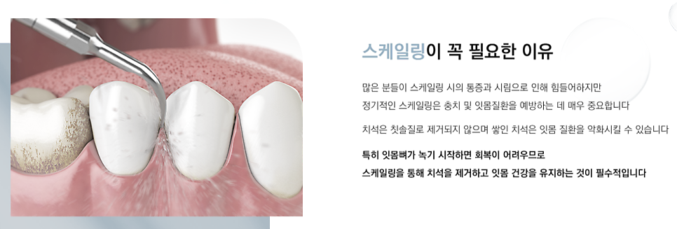 치과공포증 있어도 스케일링 편안하게 (무통스케일링) 관련 이미지 2