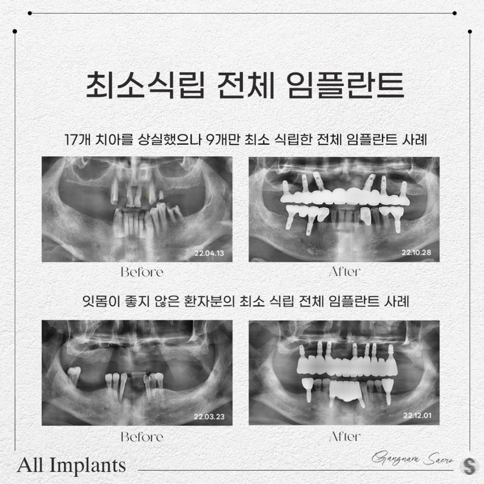 전체 임플란트 건강보험 적용 (65세이상임플란트) 관련 이미지 3
