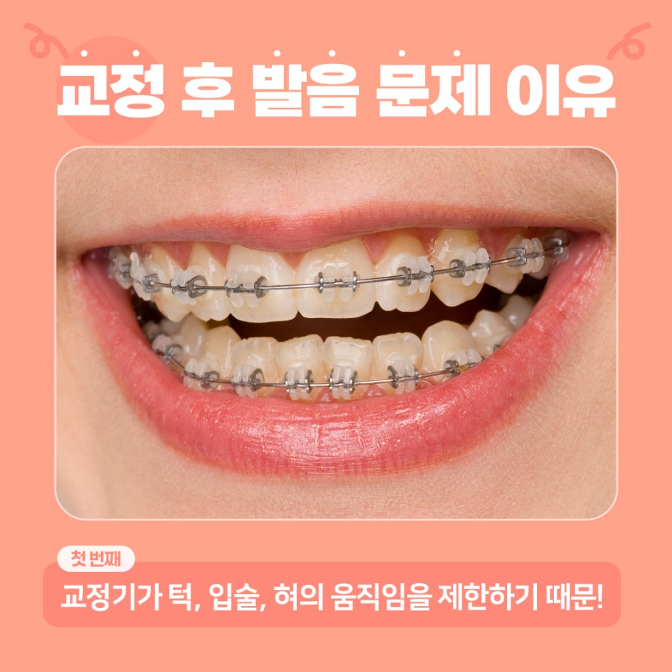 치아교정하면 발음이 안 좋아지나요? (치아교정발음) 관련 이미지 2