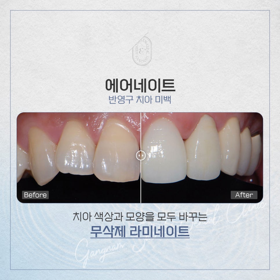치아가 하얘지는 방법 (치아미백부작용) 관련 이미지 5