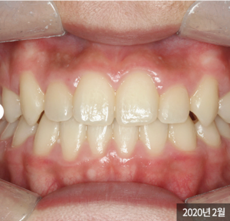 송곳니 덧니 교정없이 방치하면 발생하는 문제? 관련 이미지 3