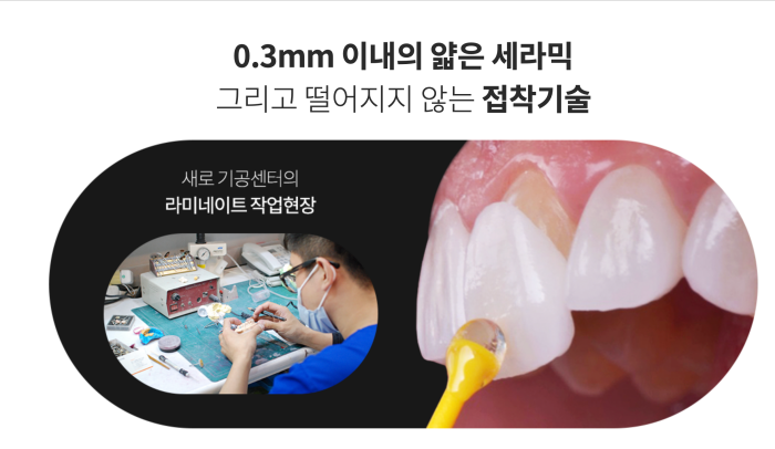 연예인라미네이트, 강남새로치과 에어네이트 관련 이미지 7