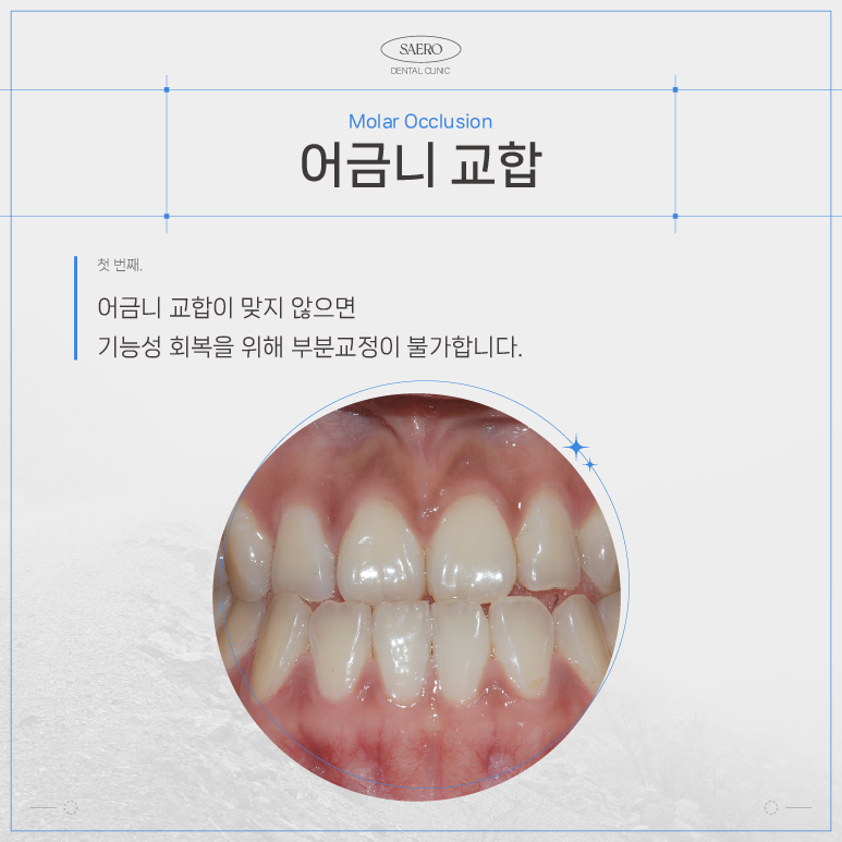 LPA MTA 부분교정 (앞니만 교정하고 싶을 땐 전체교정 대신 부분교정) [ 강남새로치과 ] 관련 이미지 3