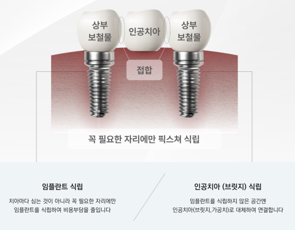 최소식립으로 최대효율 전체임플란트 (65세임플란트) 관련 이미지 5