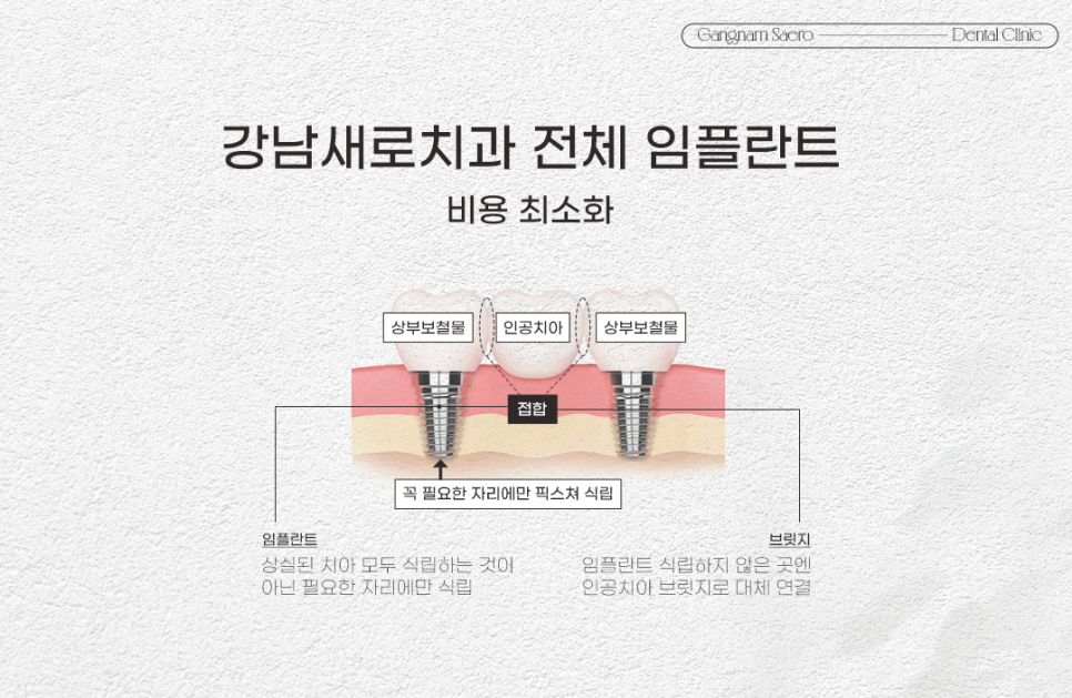 전체 임플란트 건강보험 적용 (65세이상임플란트) 관련 이미지 4