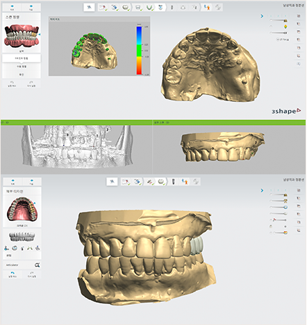 오차 줄이는 네비게이션임플란트 (붓기, 출혈, 통증 줄이는 임플란트) 관련 이미지 3