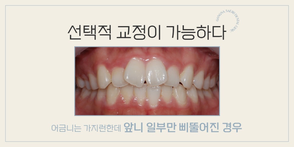 4개월만에 끝나는 부분교정 (급속교정후기) 관련 이미지 6