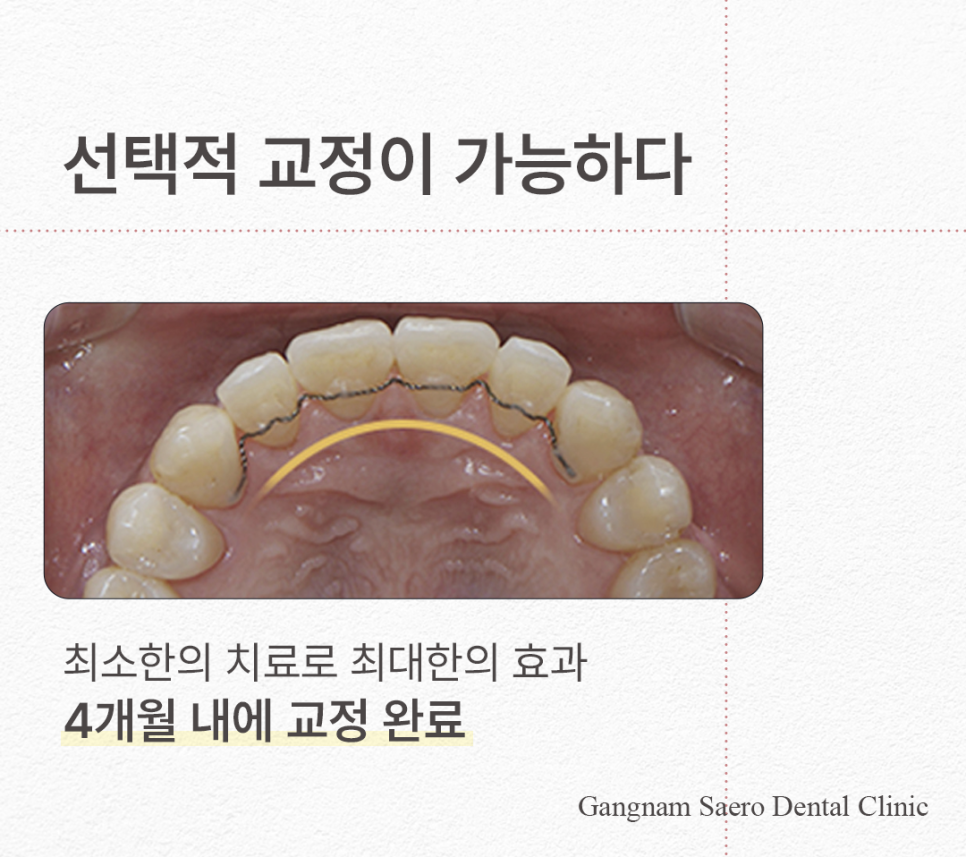 치아 일부만 교정하고 싶다면 비용과 시간을 절약하는 (급속부분교정) 관련 이미지 5