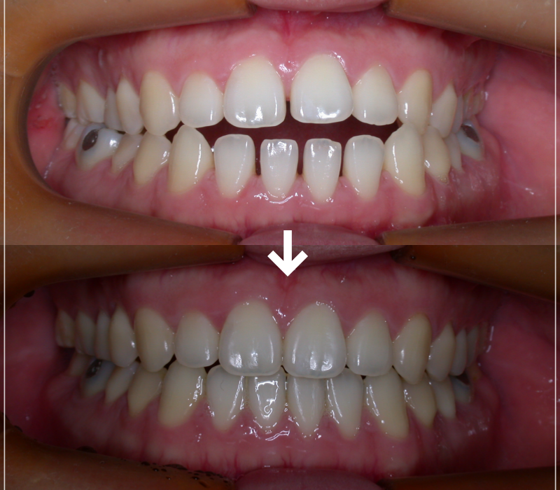 입안다물어짐 비수술로 해결이 가능하다면 관련 이미지 9