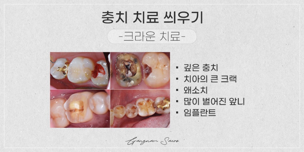 충치 때우기와 씌우기의 차이 임플란트 필요한 경우 (충치치료방법) 관련 이미지 3