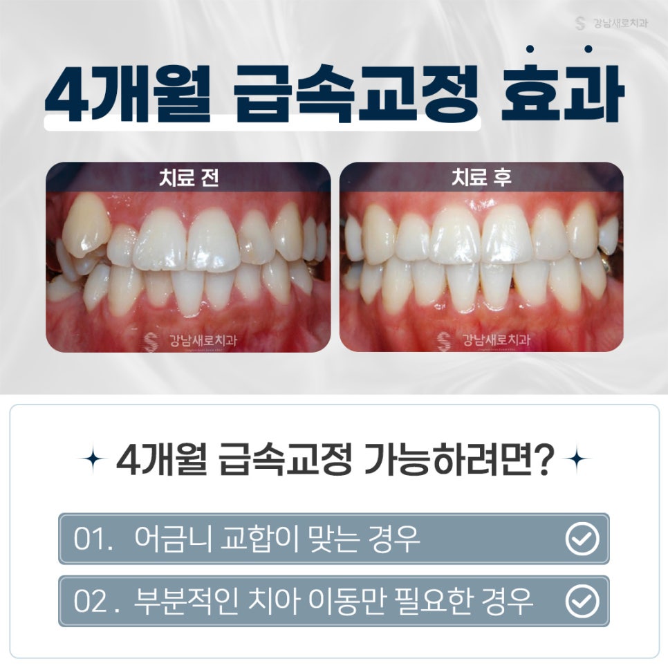 교정 비용 비교 정리 (투명교정비용) 관련 이미지 3