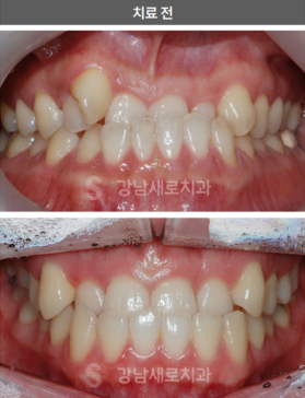 비수술 주걱턱 교정 (양악수술 대신 교정이 가능할까요?) [ 강남새로치과 ] 관련 이미지 2